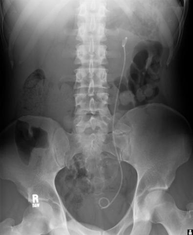 Pelvic x-ray showing